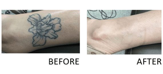 New Orleans Tattoo Removal  tattoo removal new orleans la