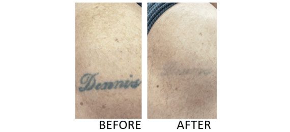 laser tatoo removal treatment at our dermatologists office in New Orleans  treating laser tatoo removal
