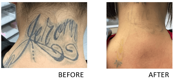 New Orleans Skin Doctor - Rose Dermatology - Laser Tattoo Removal |